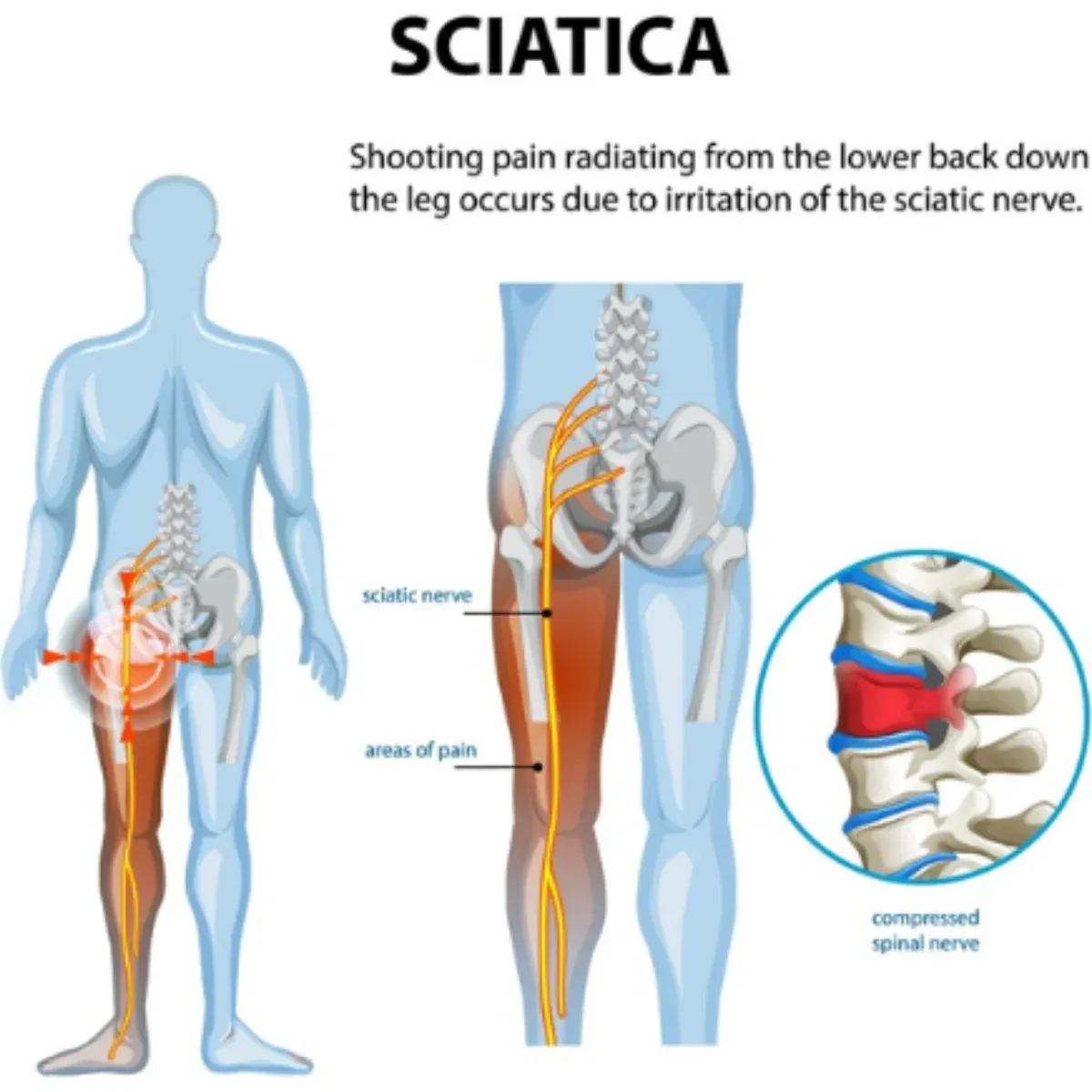 Understanding Sciatica – Symptoms and Modern Relief Options